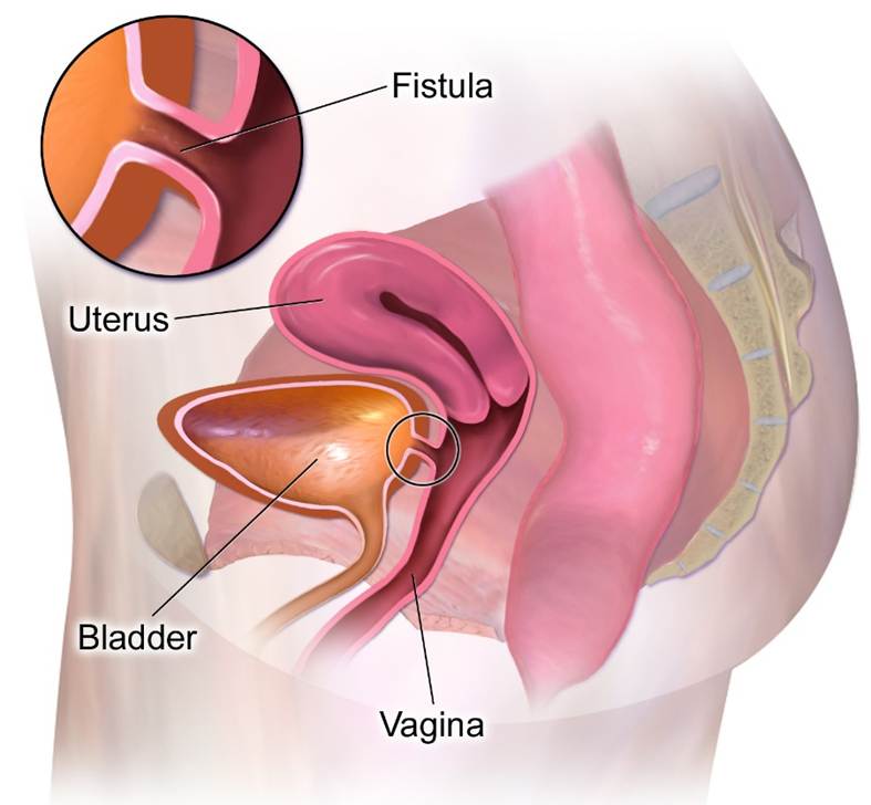Vesico-vaginal fistula repair: When reconstruction becomes the key to successful healing