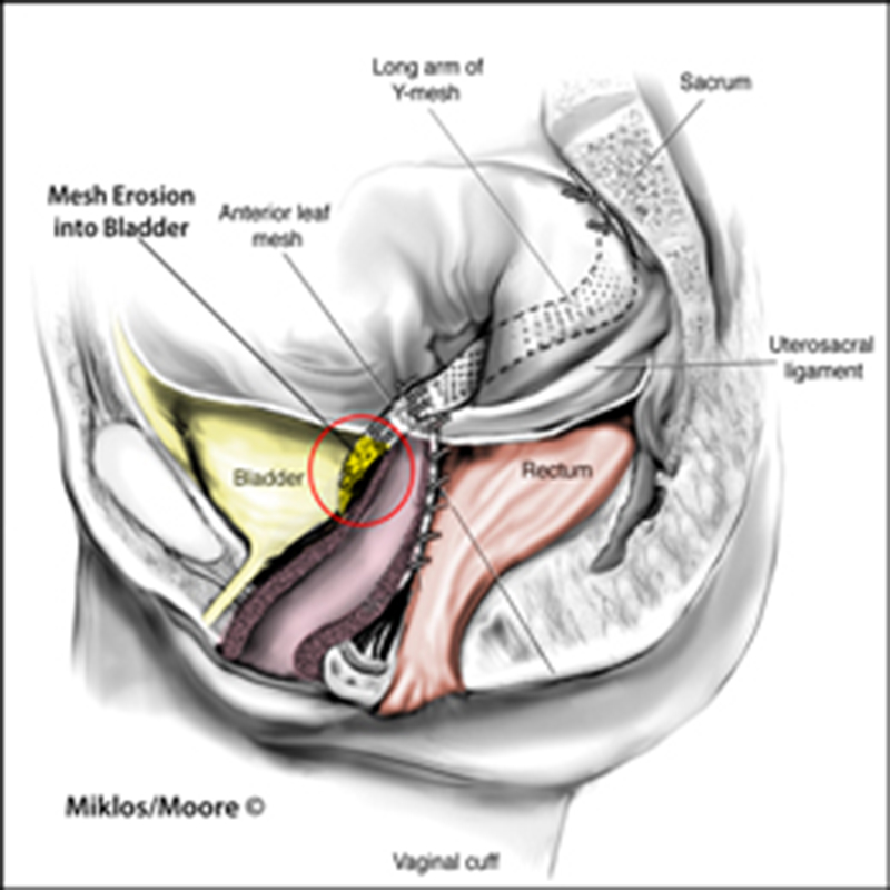 When Mesh Becomes the Problem: Understanding Mesh Erosion and Complex Pelvic Reconstruction